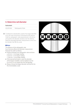 5. Determine nail diameter
Instrument
03.037.006 Radiographic Ruler
To determine nail diameter, position the image intensifier
for an AP view of the femur at the level of the isthmus.
Hold the radiographic ruler perpendicular to the femur
and position the diameter windows over the isthmus.
Read the estimated diameter measurement on the circu-
lar indicator that fills the canal.
■ Note:
The distance of the radiographic ruler
from the bone affects the diameter measurement.
Estimate the width as follows:
• 
Distance between the radiographic ruler and bone
a. 25 mm = 1 mm larger reading
b. 50 mm = 2 mm larger reading
c. 100 mm = 3 mm larger reading
• 
If the reamed technique is used, the diameter
of the largest medullary reamer applied must be
0.5 mm to 1.5 mm larger than the nail diameter
• 
Always choose the largest diameter nail that fits into
the intramedullary canal
9
TFN-ADVANCED™ Proximal Femoral Nailing System • Surgical Technique
 