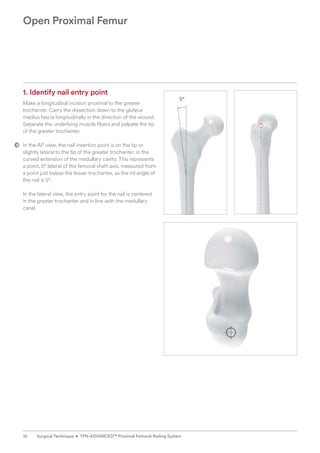 5°
Open Proximal Femur
1. Identify nail entry point
Make a longitudinal incision proximal to the greater
­
trochanter. Carry the dissection down to the gluteus
­
medius fascia longitudinally in the direction of the wound.
Separate the underlying muscle fibers and palpate the tip
of the greater trochanter.
In the AP view, the nail insertion point is on the tip or
slightly lateral to the tip of the greater trochanter, in the
curved extension of the medullary cavity. This represents
a point, 5° lateral of the femoral shaft axis, measured from
a point just below the lesser trochanter, as the ml angle of
the nail is 5°.
In the lateral view, the entry point for the nail is centered
in the greater trochanter and in line with the medullary
canal.
10 Surgical Technique • TFN-ADVANCED™ Proximal Femoral Nailing System
 