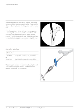 Alternative technique
Instruments
03.037.008 Awl B 8/4.7 mm, curved, cannulated
or
03.037.007 Awl B 8/4.7 mm, straight, cannulated
The entry point can also be determined by using the awl.
After initial opening with the awl, insert the 950 mm
reaming rod through the cannulation.
Alternatively the guide wire can be inserted without the
protection sleeve and multiple wire guide. The protection
sleeve and wire guide can then be passed over the guide
wire.
If the first guide wire is inserted in an incorrect position,
a second guide wire can be inserted through one of the
additional holes in the multi hole drill sleeve at either
4mm or 6mm from the central hole. Once the guide wire
is in the desired entry point, remove the first guide wire.
Open Proximal Femur
12 Surgical Technique • TFN-ADVANCED™ Proximal Femoral Nailing System
 