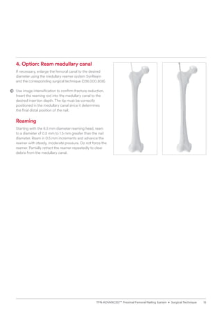 4. Option: Ream medullary canal
If necessary, enlarge the femoral canal to the desired
diameter using the medullary reamer system SynReam
and the corresponding surgical technique (036.000.808).
Use image intensification to confirm fracture reduction.
Insert the reaming rod into the medullary canal to the
desired insertion depth. The tip must be correctly
positioned in the medullary canal since it determines
the final distal position of the nail.
Reaming
Starting with the 8.5 mm diameter reaming head, ream ­
to a diameter of 0.5 mm to 1.5 mm greater than the nail
diameter. Ream in 0.5 mm increments and advance the
reamer with steady, moderate pressure. Do not force the
reamer. Partially retract the reamer repeatedly to clear
debris from the medullary canal.
15
TFN-ADVANCED™ Proximal Femoral Nailing System • Surgical Technique
 