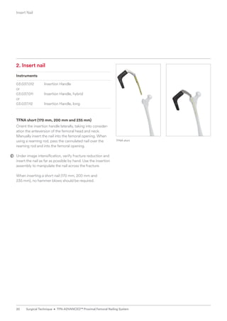 2. Insert nail
Instruments
03.037.012 Insertion Handle
or
03.037.011 Insertion Handle, hybrid
or
03.037.112 Insertion Handle, long
TFNA short (170 mm, 200 mm and 235 mm)
Orient the insertion handle laterally, taking into consider-
ation the anteversion of the femoral head and neck.
­
Manually insert the nail into the femoral opening. When
using a reaming rod, pass the cannulated nail over the
reaming rod and into the femoral opening.
Under image intensification, verify fracture reduction and
insert the nail as far as possible by hand. Use the insertion
assembly to manipulate the nail across the fracture.
When inserting a short nail (170 mm, 200 mm and
235 mm), no hammer blows should be required.
TFNA short
Insert Nail
20 Surgical Technique • TFN-ADVANCED™ Proximal Femoral Nailing System
 