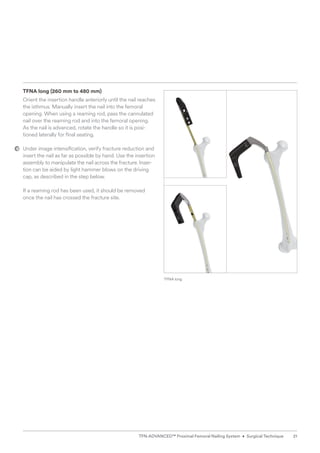 TFNA long (260 mm to 480 mm)
Orient the insertion handle anteriorly until the nail reaches
the isthmus. Manually insert the nail into the femoral
opening. When using a reaming rod, pass the cannulated
nail over the reaming rod and into the femoral opening.
As the nail is advanced, rotate the handle so it is posi-
tioned laterally for final seating.
Under image intensification, verify fracture reduction and
insert the nail as far as possible by hand. Use the insertion
assembly to manipulate the nail across the fracture. Inser-
tion can be aided by light hammer blows on the driving
cap, as described in the step below.
If a reaming rod has been used, it should be removed
once the nail has crossed the fracture site.
TFNA long
21
TFN-ADVANCED™ Proximal Femoral Nailing System • Surgical Technique
 