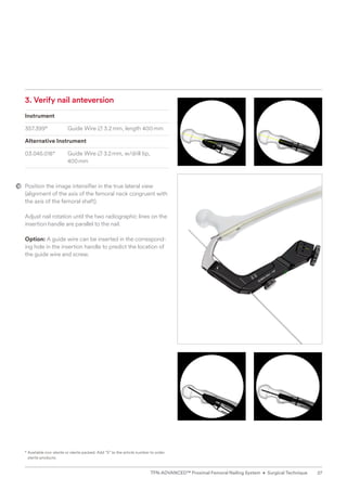 3. Verify nail anteversion
Instrument
357.399* Guide Wire B 3.2mm, length 400mm
Alternative Instrument
03.045.018* Guide Wire B 3.2mm, w/drill tip,
400mm
Position the image intensifier in the true lateral view
(alignment of the axis of the femoral neck congruent with
the axis of the femoral shaft).
Adjust nail rotation until the two radiographic lines on the
insertion handle are parallel to the nail.
Option: A guide wire can be inserted in the correspond-
ing hole in the insertion handle to predict the location of
the guide wire and screw.
* 
Available non-sterile or sterile packed. Add “S” to the article number to order
sterile products.
27
TFN-ADVANCED™ Proximal Femoral Nailing System • Surgical Technique
 