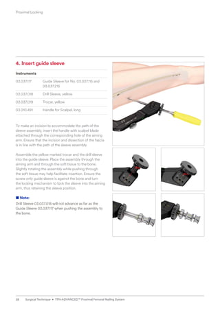 4. Insert guide sleeve
Instruments
03.037.117 Guide Sleeve for No. 03.037.115 and
03.037.215
03.037.018 Drill Sleeve, yellow
03.037.019 Trocar, yellow
03.010.491 Handle for Scalpel, long
To make an incision to accommodate the path of the
sleeve assembly, insert the handle with scalpel blade
attached through the corresponding hole of the aiming
arm. Ensure that the incision and dissection of the fascia
is in line with the path of the sleeve assembly.
Assemble the yellow marked trocar and the drill sleeve
into the guide sleeve. Place the assembly through the
aiming arm and through the soft tissue to the bone.
Slightly rotating the assembly while pushing through
the soft tissue may help facilitate insertion. Ensure the
screw only guide sleeve is against the bone and turn
the locking mechanism to lock the sleeve into the aiming
arm, thus retaining the sleeve position.
■ Note:
Drill Sleeve 03.037.018 will not advance as far as the
Guide Sleeve 03.037.117 when pushing the assembly to
the bone.
Proximal Locking
28 Surgical Technique • TFN-ADVANCED™ Proximal Femoral Nailing System
 