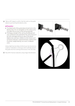 Take an AP image to confirm that the tooth on the guide
sleeve is just touching the lateral cortex.
  
▲ Precaution:
• The distal tooth of the guide sleeve should rest on the
lateral cortex. Do not overtighten on the cortex as this
may affect the accuracy of the aiming assembly.
• The fatigue strength of the nail may be affected and
may contribute to the potential for the nail to fracture if
the nail is damaged during any step of the helical
blade/screw reaming in addition to other factors such
as fracture ­
reduction, surgical technique, obesity, level
of activity/ weight-bearing, non-union, or delayed
union.
Using a light hammer blow, hit the trocar into the bone to
create an indentation in the bone which will help prevent
the guide wire from skiving off the bone in the next step.
Reconfirm fracture reduction using image intensification.
29
TFN-ADVANCED™ Proximal Femoral Nailing System • Surgical Technique
 