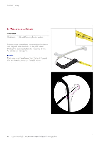 6. Measure screw length
Instrument
03.037.020 Direct Measuring Device, yellow
To measure the screw length, pass the measuring device
over the guide wire to the back of the guide sleeve. ­
The length is read directly from the measuring device. ­
No calculations are required.
■ Note:
The measurement is calibrated from the tip of the guide
wire to the tip of the tooth on the guide sleeve.
Proximal Locking
32 Surgical Technique • TFN-ADVANCED™ Proximal Femoral Nailing System
 
