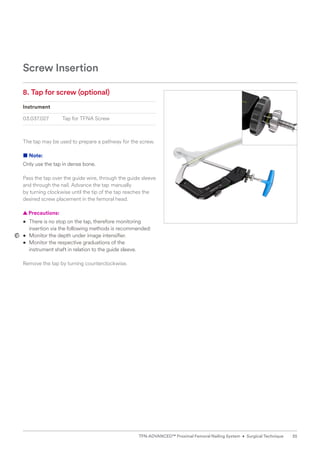 8. Tap for screw (optional)
Instrument
03.037.027 Tap for TFNA Screw
The tap may be used to prepare a pathway for the screw.
■ Note:
Only use the tap in dense bone.
Pass the tap over the guide wire, through the guide sleeve
and through the nail. Advance the tap manually
by turning clockwise until the tip of the tap reaches the
desired screw placement in the femoral head.
  
▲ Precautions:
• 
There is no stop on the tap, therefore monitoring
insertion via the following methods is recommended:
• Monitor the depth under image intensifier.
• Monitor the respective graduations of the
instrument shaft in relation to the guide sleeve.
Remove the tap by turning counterclockwise.
Screw Insertion
35
TFN-ADVANCED™ Proximal Femoral Nailing System • Surgical Technique
 