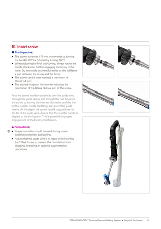 10. Insert screw
■ Starting notes:
• 
The screw advances 1.75 mm increments by turning
the handle 180° (or 3.5 mm by turning 360°).
• 
When adjusting for final positioning, always rotate the
handle clockwise, further engaging the screw in the
bone. Do not rotate counterclockwise as this will leave
a gap between the screw and the bone.
• 
The screw can be over inserted a maximum of
1 (one) full turn.
• 
The etched image on the inserter indicates the
orientation of the lateral oblique end of the screw.
Pass the screw insertion assembly over the guide wire,
through the guide sleeve and through the nail. Advance
the screw by turning the inserter clockwise until the line
on the inserter meets the flange surface of the guide
sleeve. At this depth the screw tip will be positioned at
the tip of the guide wire. Assure that the inserter handle is
aligned to the aiming arm. This is essential for proper
­
engagement of the locking mechanism.
  
▲ Precautions:
• 
Image intensifier should be used during screw
insertion to monitor positioning.
• 
Assure that the guide wire is in place while inserting
the TFNA Screw to prevent the cannulation from
clogging, impeding an optional augmentation
procedure.
37
TFN-ADVANCED™ Proximal Femoral Nailing System • Surgical Technique
 