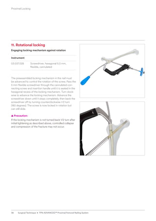 11. Rotational locking
Engaging locking mechanism against rotation
Instrument
03.037.028 Screwdriver, hexagonal 5.0 mm,
flexible, cannulated
The preassembled locking mechanism in the nail must
be advanced to control the rotation of the screw. Pass the
5 mm flexible screwdriver through the cannulated con-
necting screw and insertion handle until it is seated in the
hexagonal recess of the locking mechanism. Turn clock-
wise to advance the locking mechanism. Advance the
screwdriver down until it stops completely, then back the
screwdriver off by turning counterclockwise 1/2 turn
(180 degrees). The screw is now locked in rotation but
can still slide.
  
▲ Precaution:
If the locking mechanism is not turned back 1/2 turn after
initial tightening as described above, controlled collapse
and compression of the fracture may not occur.
Proximal Locking
38 Surgical Technique • TFN-ADVANCED™ Proximal Femoral Nailing System
 