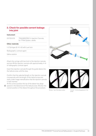 2. 
Check for possible cement leakage
into joint
Instrument
03.702.121S TRAUMACEM V+ Injection Cannula,
for TFNA System, sterile
Other materials
1–2 Syringes (6–10 ml) with Luer lock
Radiographic contrast agent
Saline solution
Attach the syringe with luer lock to the injection cannula
and pre-fill the injection cannula with approximately 4 ml
of radiographic contrast agent.
Insert the injection cannula through the guide sleeve into
the helical screw until the stop.
Confirm that the selected length on the injection cannula
corresponds with the length of the helical screw and
­
verify under image intensification that the injection ­
cannula
is fully inserted.
At the correct position the tip of the sleeve has disap-
peared in the lateral end of the helical screw. Monitor the
correct position of the sleeve throughout the procedure.
Correct – tip has disappeared in the
screw.
Wrong – tip of the sleeve visible.
43
TFN-ADVANCED™ Proximal Femoral Nailing System • Surgical Technique
 