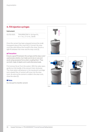 1
2 3
4. Fill injection syringes
Instrument
03.702.150S TRAUMACEM V+ Syringe Kit,
4 × 1 mL, 2 × 2 mL, sterile
Once the cement has been prepared remove the small,
transparent plug of the mixer lid (1). Connect the stop-
cock (the side without the funnel) to the mixer. Ensure a
tight fit between the mixer and the stop-cock (2).
  
▲ Precaution:
Ensure a good fit between the syringe and the stop-cock/­
used access solution, but make sure to be on axis and
avoid using excessive force when coupling them. They
are both made of plastic and could otherwise break.
First remove the air from the system. With the valve open,
gently turn the handle of the cement mixer clockwise.
The mixer piston will advance in the translucent cartridge
and a steady flow of cement will move into the stop-
cock. As soon as the cement is visible in the stop-cock,
close the valve (3).
■ Note:
Do not push to transfer cement.
Open Close
Augmentation
46 Surgical Technique • TFN-ADVANCED™ Proximal Femoral Nailing System
 