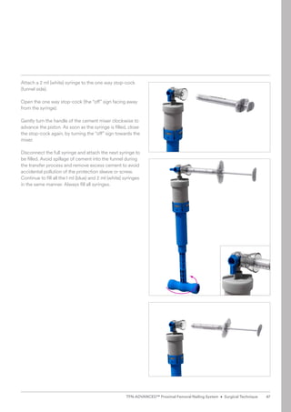 Attach a 2 ml (white) syringe to the one way stop-cock
(funnel side).
Open the one way stop-cock (the “off” sign facing away
from the syringe).
Gently turn the handle of the cement mixer clockwise to
advance the piston. As soon as the syringe is filled, close
the stop-cock again, by turning the “off” sign towards the
mixer.
Disconnect the full syringe and attach the next syringe to
be filled. Avoid spillage of cement into the funnel during
the transfer process and remove excess cement to avoid
accidental pollution of the protection sleeve or screw.
Continue to fill all the1 ml (blue) and 2 ml (white) ­
syringes
in the same manner. Always fill all syringes.
47
TFN-ADVANCED™ Proximal Femoral Nailing System • Surgical Technique
 