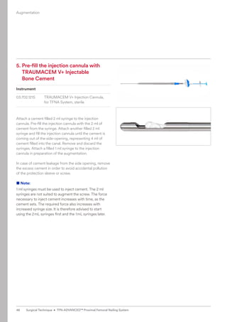 5. 
Pre-fill the injection cannula with
TRAUMACEM V+ Injectable
Bone Cement
Instrument
03.702.121S TRAUMACEM V+ Injection Cannula,
for TFNA System, sterile
Attach a cement filled 2 ml syringe to the injection
­
cannula. Pre-fill the injection cannula with the 2 ml of
­
cement from the syringe. Attach another filled 2 ml
­
syringe and fill the injection cannula until the cement is
coming out of the side-opening, representing 4 ml of
­
cement filled into the canal. Remove and discard the
­
syringes. Attach a filled 1 ml syringe to the injection
­
cannula in preparation of the augmentation.
In case of cement leakage from the side opening, remove
the excess cement in order to avoid accidental pollution
of the protection sleeve or screw.
■ Note:
1 ml syringes must be used to inject cement. The 2 ml
­
syringes are not suited to augment the screw. The force
necessary to inject cement increases with time, as the
cement sets. The required force also increases with
­
increased syringe size. It is therefore advised to start
­
using the 2mL syringes first and the 1mL syringes later.
Augmentation
48 Surgical Technique • TFN-ADVANCED™ Proximal Femoral Nailing System
 