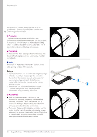 Visualization of cement during injection must be
guaranteed. Continuously monitor the cement flow
under image intensification.
  
▲ Precaution:
Do not advance the cannula more than 5 mm
over the selected head element length. This would result
in injection of cement in front of the head ­
element tip
where no additional stability is achieved and the risk of
penetration and cement leakage is increased.
  
▲ WARNING:
In the event that there is danger of cement leakage into
the joint, fracture gap or venous system, stop injection
immediately.
■ Note:

The arrow on the handle indicates the position of the
side-opening window of the cannula.
Options:
• 
Injection of cement can be continued using the plunger
when the viscosity is increasing or the cement in ­
the cavity of the injection cannula is necessary for
augmentation. Approximately 3 ml of cement
contained in the injection cannula can be injected
with the plunger.
• 
Remove the 1 ml syringe and insert the plunger.
Continue the injection using the plunger and
optimize the filling by rotating the handle.
  
▲ WARNINGS:
• 
If the extravasated cement conforms to the
architecture of the hip joint it may not need to be
removed, however if it does not conform and is
abrasive or damages the articular surface then the
extruded cement will need to be removed.
• To remove the cement, the treating physician has the
option of either hip arthroscopy, arthroplasty, or open
arthrotomy to remove the extruded pieces. The timing
of the removal is at the discretion of the physician
after appropriate evaluation of the patient.
Augmentation
50 Surgical Technique • TFN-ADVANCED™ Proximal Femoral Nailing System
 