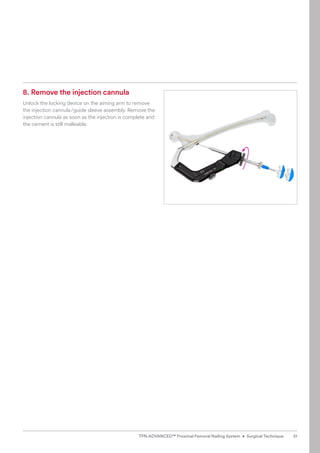 8. Remove the injection cannula
Unlock the locking device on the aiming arm to remove
the injection cannula/guide sleeve assembly. Remove the
injection cannula as soon as the injection is complete and
the cement is still malleable.
51
TFN-ADVANCED™ Proximal Femoral Nailing System • Surgical Technique
 