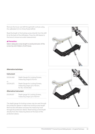Remove the trocar and drill through both cortices using
the calibrated 4.2 mm three-fluted drill bit.
Read the length of the locking screw directly from the drill
bit at the back of the drill sleeve. Press the drill sleeve to
the bone to ensure accurate measurement.
  
▲ Precaution:
Select adequate screw length to avoid protrusion of the
screw tip and irritation of soft tissue.
Alternative technique
Instrument
03.010.428 Depth Gauge for Locking Screws,
measuring range to110mm
or
03.010.072 Depth Gauge for Locking Screws,
measuring range up to 110mm,
for No. 03.010.063
Alternative Instrument
03.019.017 Depth gauge for Locking Screws, ­	
measuring range up to 100mm
The depth gauge for locking screws may be used through
the protection sleeve to determine locking screw length.
Remove the drill sleeve and pass the measuring hook
through the protection sleeve. Read locking screw length
directly from the measuring device at the back of the
­protection sleeve.
53
TFN-ADVANCED™ Proximal Femoral Nailing System • Surgical Technique
 