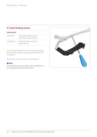 3. Insert locking screw
Instruments
03.010.518	
Screwdriver Stardrive, T25,
self-holding, length 319 mm
03.025.040 Protection Sleeve11.0/8.0,
length188 mm
Insert the appropriate 5.0 mm locking screw through
the protection sleeve using the appropriate Stardrive
screwdriver.
Remove the protection sleeve and aiming arm.
■ Note:
If using retaining screws, please refer to addendum A
for surgical technique and instruments.
Distal Locking ­
– TFNA short
54 Surgical Technique • TFN-ADVANCED™ Proximal Femoral Nailing System
 