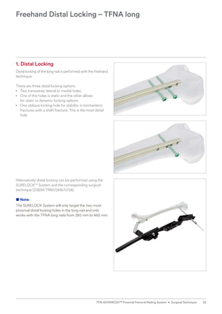 1. Distal Locking
Distal locking of the long nail is performed with the freehand
technique.
There are three distal locking options:
• Two transverse, lateral to medial holes
• One of the holes is static and the other allows
for static or dynamic locking options
• One oblique locking hole for stability in ­
trochanteric
fractures with a shaft fracture. This is the most distal
hole.
Freehand Distal Locking – TFNA long
Alternatively distal locking can be performed using the
SURELOCKTM
System and the corresponding surgical
technique (DSEM/TRM/0816/0728).
■ Note:
The SURELOCK System will only target the two most
proximal distal locking holes in the long nail and only
works with the TFNA long nails from 280 mm to 460 mm.
55
TFN-ADVANCED™ Proximal Femoral Nailing System • Surgical Technique
 
