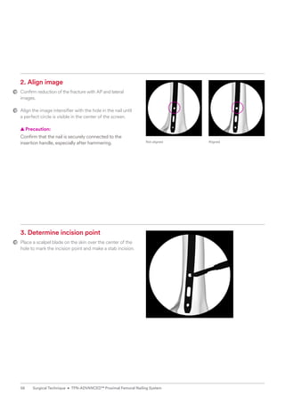 2. Align image
Confirm reduction of the fracture with AP and lateral
images.
Align the image intensifier with the hole in the nail until
a perfect circle is visible in the center of the screen.
  
▲ Precaution:
Confirm that the nail is securely ­
connected ­
to the
­
insertion handle, especially after hammering.
3. Determine incision point
Place a scalpel blade on the skin over the center of the
hole to mark the incision point and make a stab incision.
Not aligned Aligned
56 Surgical Technique • TFN-ADVANCED™ Proximal Femoral Nailing System
 