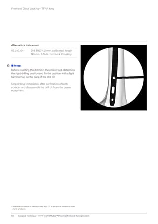 Alternative instrument
03.010.104* Drill Bit B 4.2 mm, calibrated, length
145 mm, 3-flute, for Quick Coupling
■ Note:
Before inserting the drill bit in the power tool, determine
the right drilling position and fix the position with a light
hammer tap on the back of the drill bit.
Stop drilling immediately after perforation of both
­
cortices and disassemble the drill bit from the power
equipment.
* 
Available non-sterile or sterile packed. Add “S” to the article number to order
sterile products.
Freehand Distal Locking – TFNA long
58 Surgical Technique • TFN-ADVANCED™ Proximal Femoral Nailing System
 
