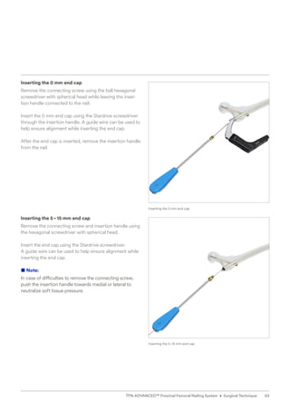 Inserting the 0 mm end cap
Remove the connecting screw using the ball hexagonal
screwdriver with spherical head while leaving the inser-
tion handle connected to the nail.
Insert the 0 mm end cap using the Stardrive screwdriver
through the insertion handle. A guide wire can be used to
help ensure alignment while inserting the end cap.
After the end cap is inserted, remove the insertion ­
handle
from the nail.
Inserting the 5–15 mm end cap
Remove the connecting screw and insertion handle ­
using
the hexagonal screwdriver with spherical head.
Insert the end cap using the Stardrive screwdriver.
A guide wire can be used to help ensure alignment while
inserting the end cap.
■ Note:
In case of difficulties to remove the connecting screw,
push the insertion handle towards medial or lateral to
neutralize soft tissue pressure.
Inserting the 0 mm end cap
Inserting the 5–15 mm end cap
63
TFN-ADVANCED™ Proximal Femoral Nailing System • Surgical Technique
 