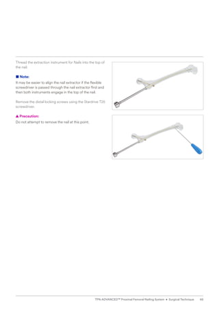 Thread the extraction instrument for Nails into the top of
the nail.
■ Note:
It may be easier to align the nail extractor if the flexible
screwdriver is passed through the nail extractor first and
then both instruments engage in the top of the nail.
Remove the distal locking screws using the Stardrive T25
screwdriver.
  
▲ Precaution:
Do not attempt to remove the nail at this point.
65
TFN-ADVANCED™ Proximal Femoral Nailing System • Surgical Technique
 