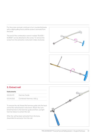 3. Extract nail
Instruments
03.010.170 Hammer Guide
03.010.522 Combined Hammer, 500 g
To remove the nail, thread the hammer guide onto the back
end of the nail extraction instrument. Attach the com-
bined hammer to the hammer guide and then use light
hammer blows to extract the nail.
After the nail has been extracted from the bone,
­
dissemble the extractor from the nail.
For the screw removal, continue to turn counterclockwise
with a slight pulling force until the screw is removed from
the bone.
The end of the combination wrench marked “BLADE/
SCREW” can be attached to the screw. To remove the
screw from the extraction instrument rotate clockwise.
67
TFN-ADVANCED™ Proximal Femoral Nailing System • Surgical Technique
 