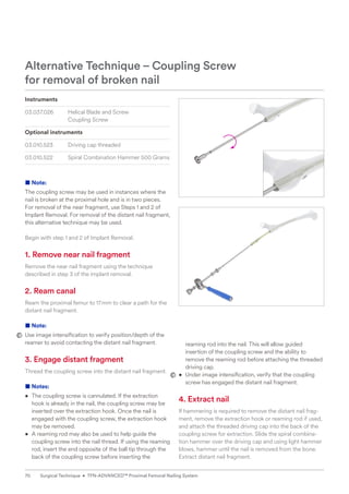 Instruments
03.037.026 Helical Blade and Screw
Coupling Screw
Optional instruments
03.010.523 Driving cap threaded
03.010.522 Spiral Combination Hammer 500 Grams
■ Note:
The coupling screw may be used in instances where the
nail is broken at the proximal hole and is in two pieces.
For removal of the near fragment, use Steps 1 and 2 of
Implant Removal. For removal of the distant nail fragment,
this alternative technique may be used.
Begin with step 1 and 2 of Implant Removal.
1. Remove near nail fragment
Remove the near nail fragment using the technique
­
described in step 3 of the implant removal.
2. Ream canal
Ream the proximal femur to 17mm to clear a path for the
distant nail fragment.
■ Note:
Use image intensification to verify position/depth of the
reamer to avoid contacting the distant nail fragment.
3. Engage distant fragment
Thread the coupling screw into the distant nail fragment.
■ Notes:
• The coupling screw is cannulated. If the extraction
hook is already in the nail, the coupling screw may be
inserted over the extraction hook. Once the nail is
engaged with the coupling screw, the extraction hook
may be removed.
• A reaming rod may also be used to help guide the
coupling screw into the nail thread. If using the reaming
rod, insert the end opposite of the ball tip through the
back of the coupling screw before inserting the
reaming rod into the nail. This will allow guided
insertion of the coupling screw and the ability to
remove the reaming rod before attaching the threaded
driving cap.
• Under image intensification, verify that the coupling
screw has engaged the distant nail fragment.
4. Extract nail
If hammering is required to remove the distant nail frag-
ment, remove the extraction hook or reaming rod if used,
and attach the threaded driving cap into the back of the
coupling screw for extraction. Slide the spiral combina-
tion hammer over the driving cap and using light hammer
blows, hammer until the nail is removed from the bone.
Extract distant nail fragment.
Alternative Technique – Coupling Screw
for removal of broken nail
70 Surgical Technique • TFN-ADVANCED™ Proximal Femoral Nailing System
 