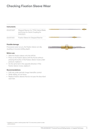 Instruments
03.037.022* Stepped Reamer for TFNA Helical Blade
and Screw for Quick Coupling for
DHS/DCS
03.037.023 Fixation Sleeve for Stepped Reamer
Possible damage
If excessive wear occurs, the fixation sleeve can slip,
resulting in incorrect drilling depth.
Before use:
• Slide the fixation sleeve onto the drill bit.
• Press on the fixation sleeve with the thumb without
pressing the button. If the fixation sleeve moves under
pressure, replace it.
• Do the same test in the opposite direction. If the
fixation sleeve moves, replace it.
Recommendations:
• Drill only under periodic image intensifier control.
• While drilling, do not force.
• Replace fixation sleeves that do not pass the described
wear test.
Checking Fixation Sleeve Wear
* 
Available non-sterile or sterile packed. Add “S” to the article number to order
sterile products.
71
TFN-ADVANCED™ Proximal Femoral Nailing System • Surgical Technique
 