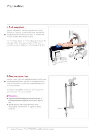 Preparation
1. Position patient
Position the patient in the lateral decubitus or supine
position on a fracture or radiolucent table. Position the
image intensifier to enable visualization of the proximal
femur in both the AP and lateral planes.
For unimpeded access to the medullary canal, abduct the
upper part of the body approximately 10–15° to the
contralateral side (or adduct the affected leg by 10–15°).
2. Fracture reduction
Perform closed reduction manually by axial traction ­
under
image intensifier control. The use of the large distractor
(refer to Instructions for Use) may be appropriate in cer-
tain circumstances.
If reduction cannot be achieved in a closed approach,
open reduction may be considered.
  
▲ Precautions:
• Instruments and screws may have sharp edges or
moving joints that may pinch or tear user’s glove or
skin.
• Handle devices with care and dispose worn
bone cutting instruments in an approved sharps
container.
6 Surgical Technique • TFN-ADVANCED™ Proximal Femoral Nailing System
 