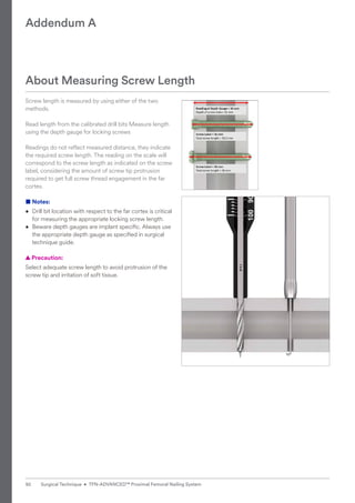 Screw length is measured by using either of the two
methods.
Read length from the calibrated drill bits Measure length
using the depth gauge for locking screws
Readings do not reflect measured distance, they indicate
the required screw length. The reading on the scale will
correspond to the screw length as indicated on the screw
label, considering the amount of screw tip protrusion
required to get full screw thread engagement in the far
cortex.
■ Notes:
• Drill bit location with respect to the far cortex is critical
for measuring the appropriate locking screw length.
• Beware depth gauges are implant specific. Always use
the appropriate depth gauge as specified in surgical
technique guide.
  
▲ Precaution:
Select adequate screw length to avoid protrusion of the
screw tip and irritation of soft tissue.
About Measuring Screw Length
Addendum A
92 Surgical Technique • TFN-ADVANCED™ Proximal Femoral Nailing System
 