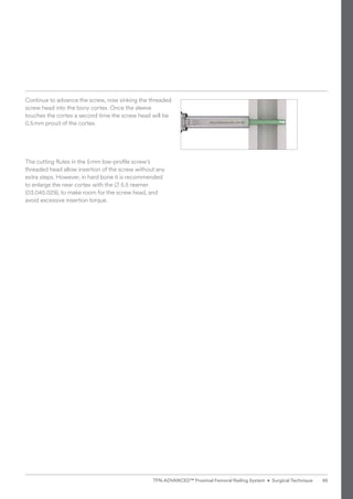 Continue to advance the screw, now sinking the threaded
screw head into the bony cortex. Once the sleeve
touches the cortex a second time the screw head will be
0.5mm proud of the cortex.
The cutting flutes in the 5mm low-profile screw’s
threaded head allow insertion of the screw without any
extra steps. However, in hard bone it is recommended ­
to enlarge the near cortex with the B 5.5 reamer
(03.045.029), to make room for the screw head, and
avoid excessive insertion torque.
95
TFN-ADVANCED™ Proximal Femoral Nailing System • Surgical Technique
 