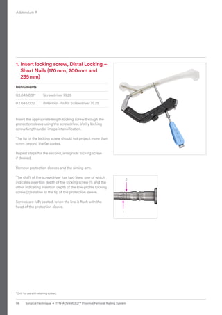2
1
1. 
Insert locking screw, Distal Locking –
Short Nails (170mm, 200mm and
235mm)
Instruments
03.045.001* Screwdriver XL25
03.045.002 Retention Pin for Screwdriver XL25
Insert the appropriate length locking screw through the
protection sleeve using the screwdriver. Verify locking
screw length under image intensiﬁcation.
The tip of the locking screw should not project more than
4mm beyond the far cortex.
Repeat steps for the second, antegrade locking screw
if desired.
Remove protection sleeves and the aiming arm.
The shaft of the screwdriver has two lines, one of which
indicates insertion depth of the locking screw (1), and the
other indicating insertion depth of the low-profile locking
screw (2) relative to the tip of the protection sleeve.
Screws are fully seated, when the line is flush with the
head of the protection sleeve.
*Only for use with retaining screws.
Addendum A
96 Surgical Technique • TFN-ADVANCED™ Proximal Femoral Nailing System
 