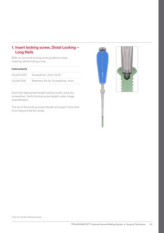 1. 
Insert locking screw, Distal Locking –
Long Nails
Refer to proximal locking screw guidance when
inserting distal locking screw.
Instruments
03.045.003* Screwdriver, short, XL25
03.045.004 Retention Pin for Screwdriver, short
Insert the appropriate length locking screw using the
screwdriver. Verify locking screw length under image
intensiﬁcation.
The tip of the locking screw should not project more than
2mm beyond the far cortex.
*Only for use with retaining screws.
97
TFN-ADVANCED™ Proximal Femoral Nailing System • Surgical Technique
 