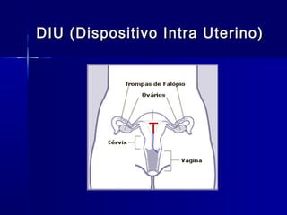 DIU (Dispositivo Intra Uterino)

T

 