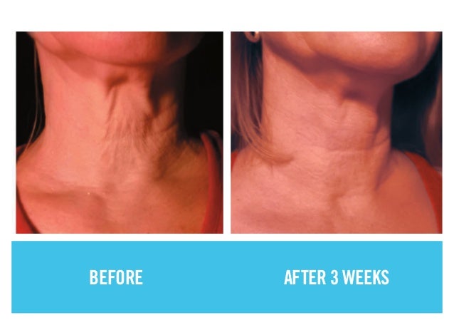 rodan and fields neck cream