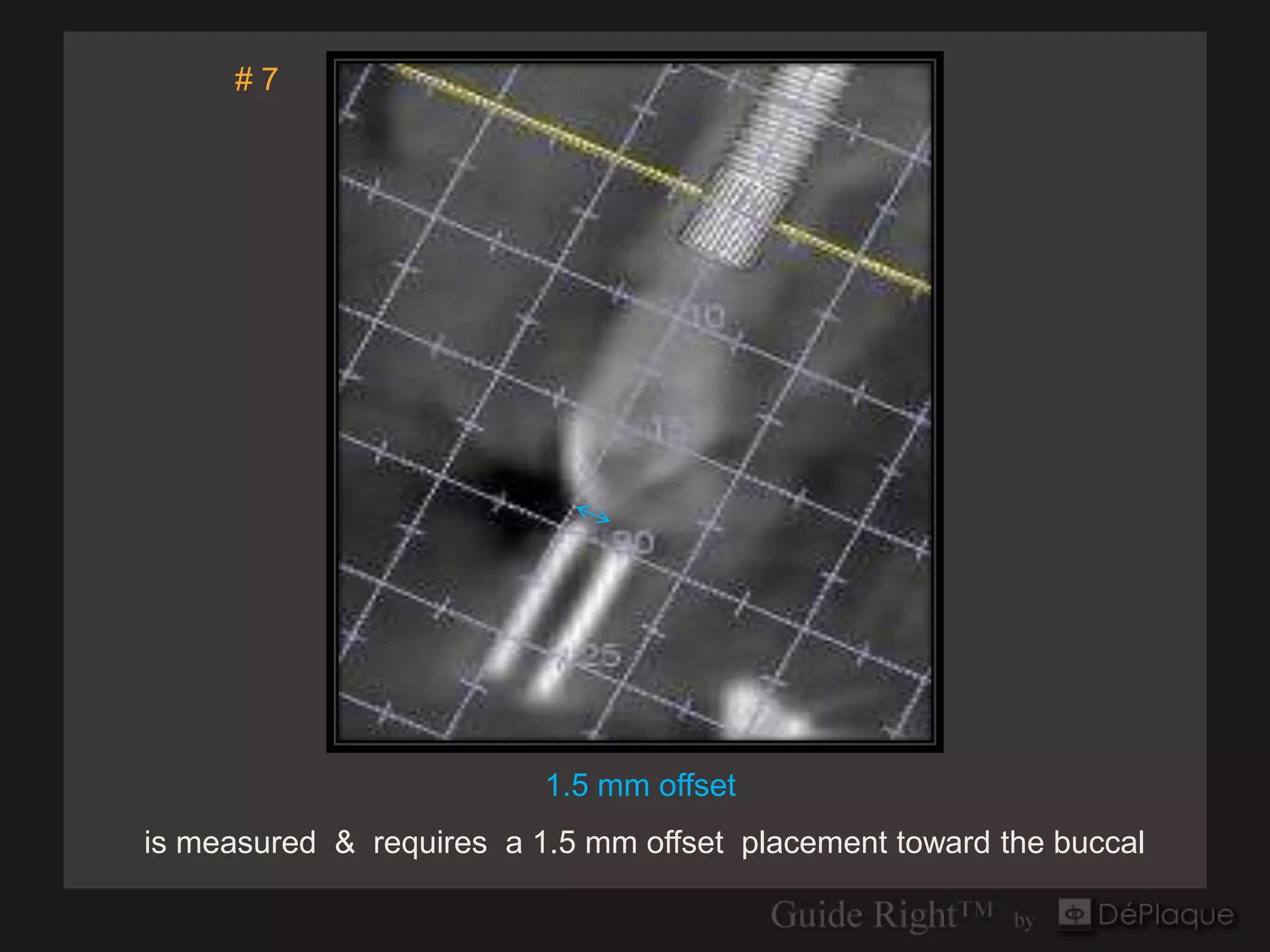 #7



                                `




                          1.5 mm offset
is measured & requires a 1.5 mm offset placement toward the buccal
 