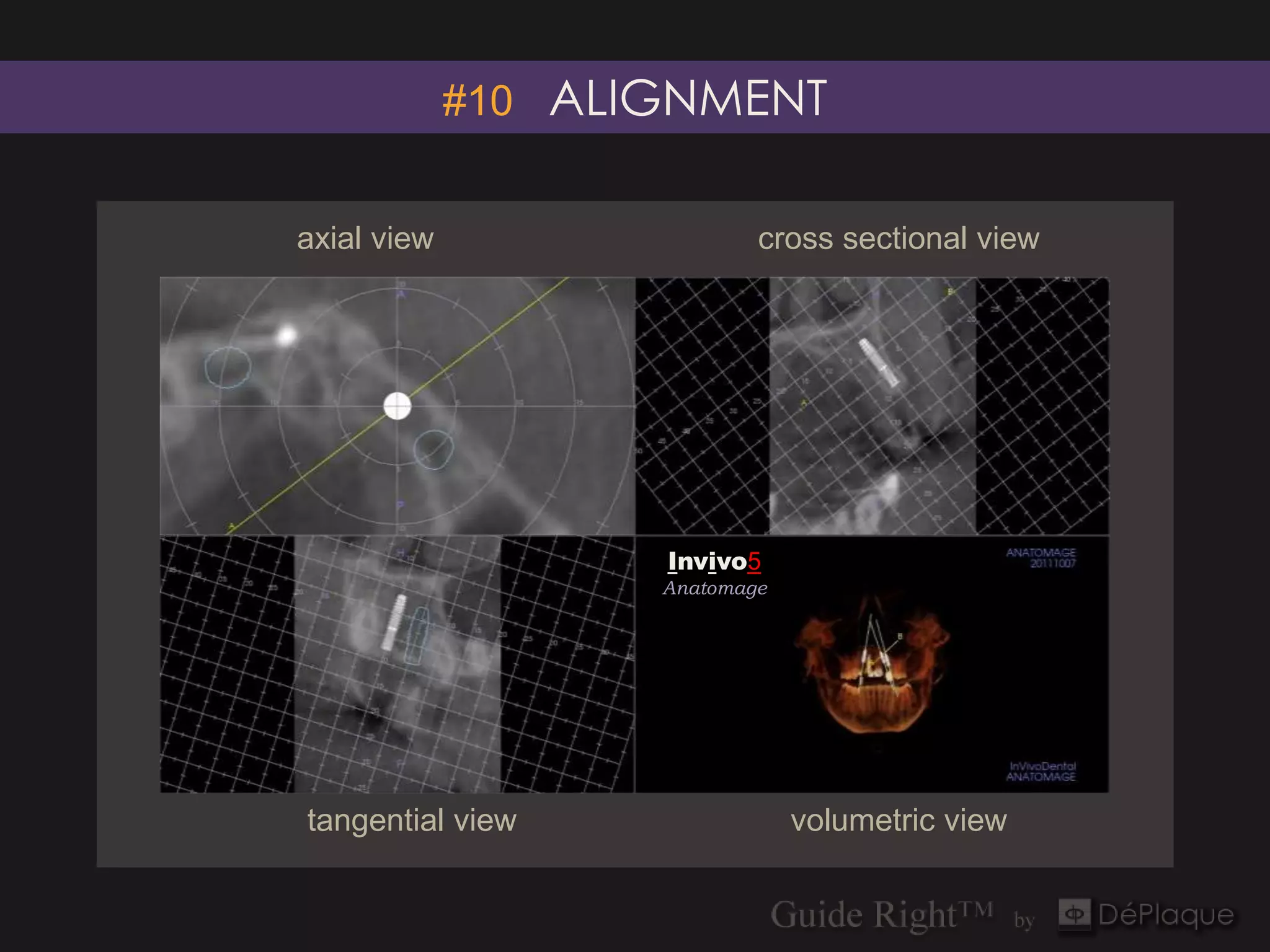 #10 ALIGNMENT


axial view                  cross sectional view




                    Invivo5
                    Anatomage




tangential view                 volumetric view
 