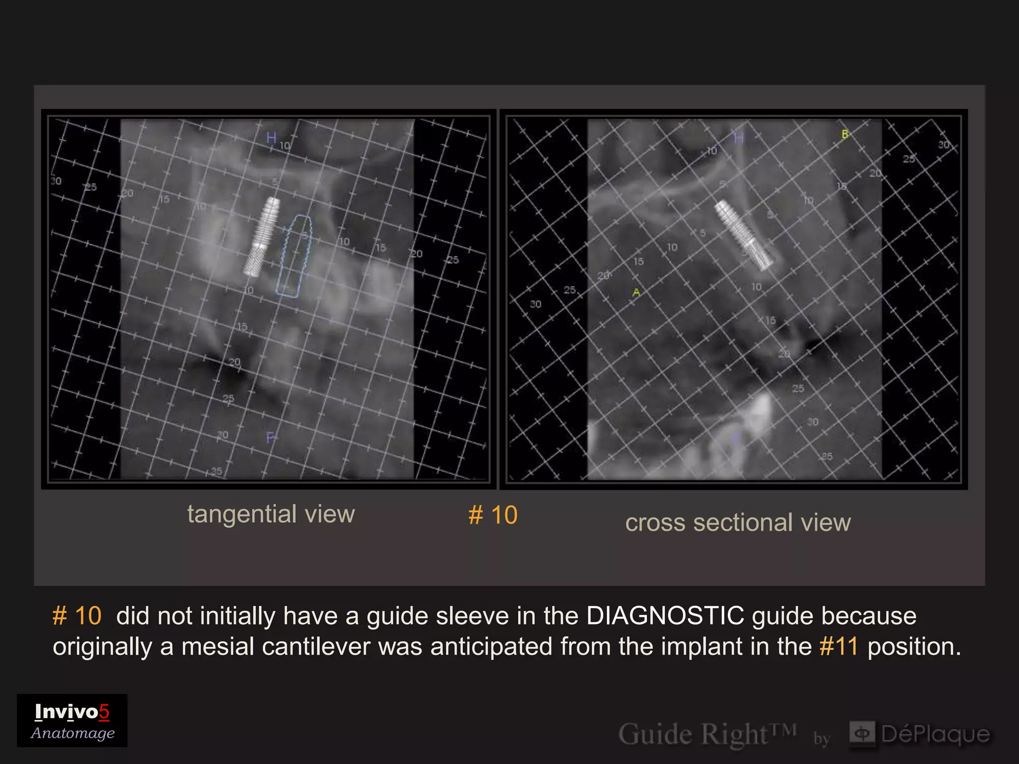 tangential view           # 10          cross sectional view


  # 10 did not initially have a guide sleeve in the DIAGNOSTIC guide because
  originally a mesial cantilever was anticipated from the implant in the #11 position.

Invivo5
Anatomage
 