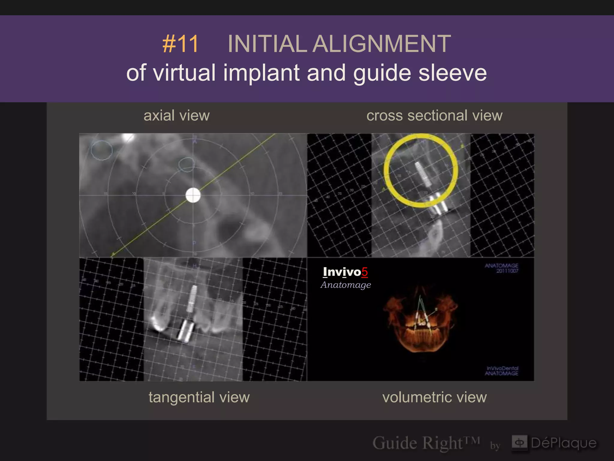 #11 INITIAL ALIGNMENT
of virtual implant and guide sleeve
 axial view                 cross sectional view




                    Invivo5
                    Anatomage




  tangential view               volumetric view
 