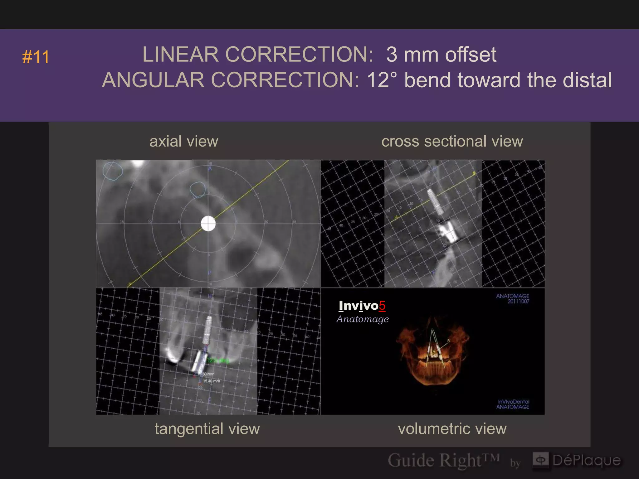 #11      LINEAR CORRECTION: 3 mm offset
      ANGULAR CORRECTION: 12° bend toward the distal

          axial view               cross sectional view




                            Invivo5
                            Anatomage




          tangential view               volumetric view
 