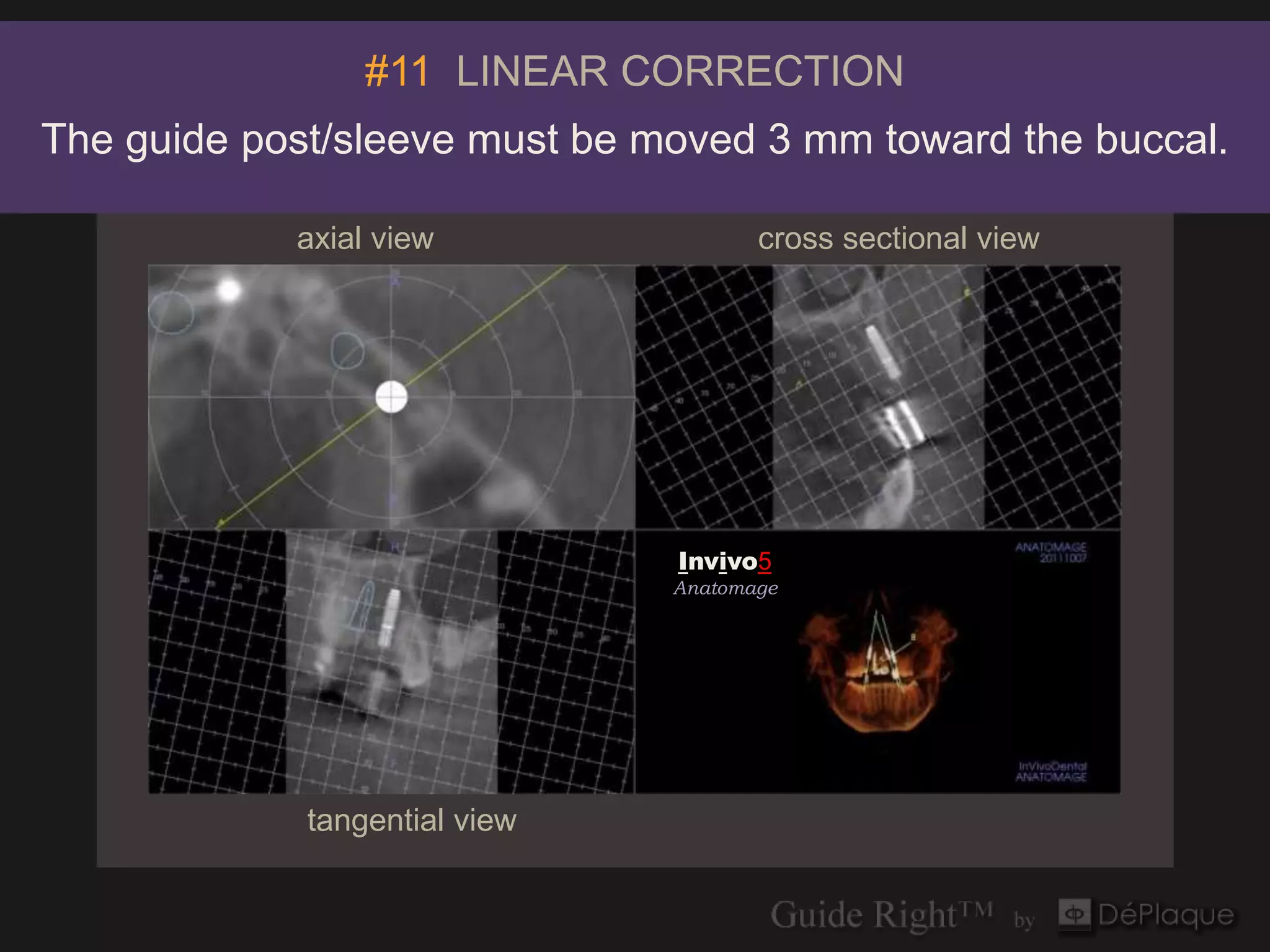 #11 LINEAR CORRECTION
The guide post/sleeve must be moved 3 mm toward the buccal.

            axial view                cross sectional view




                               Invivo5
                               Anatomage




             tangential view
 