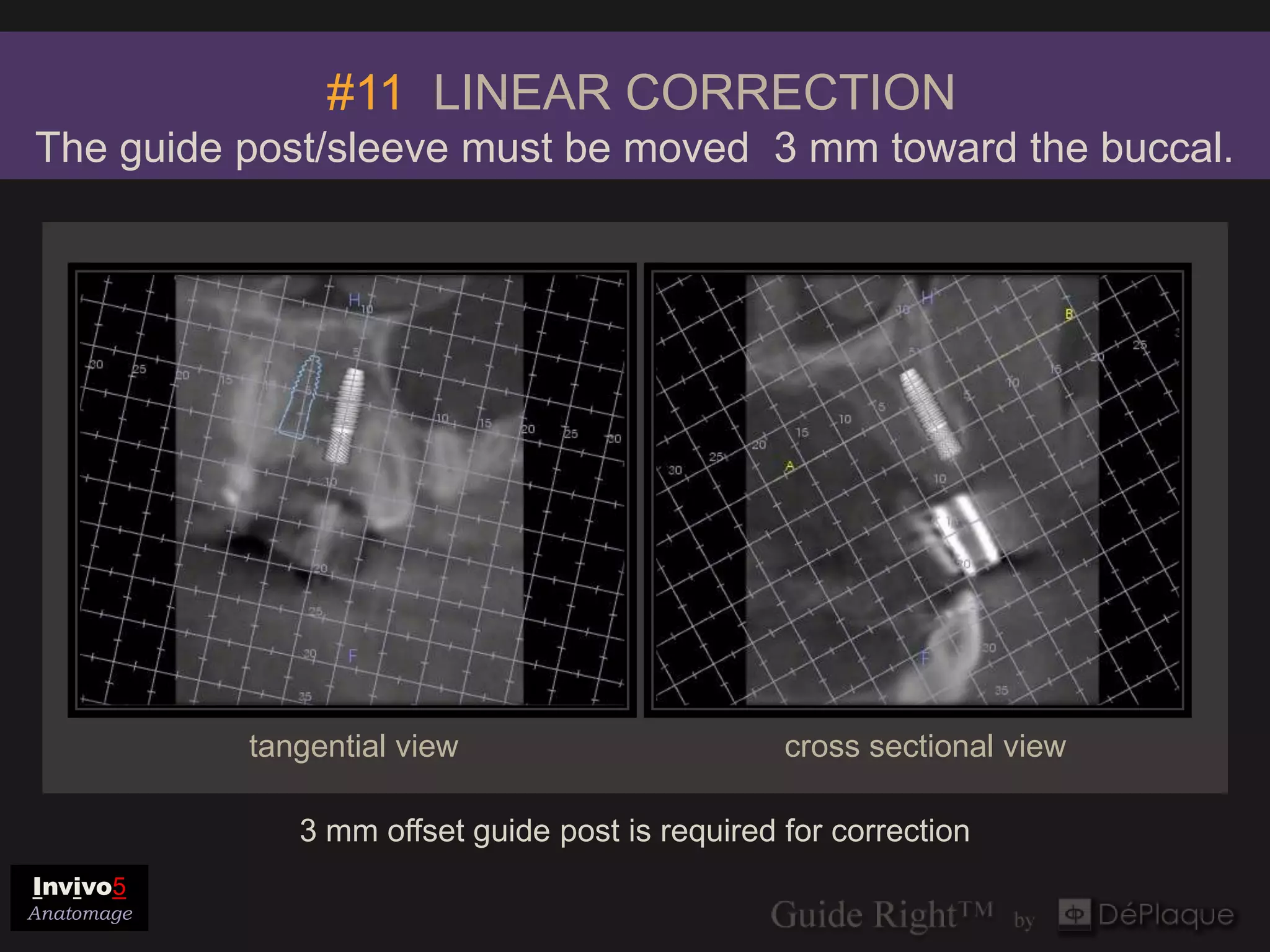 #11 LINEAR CORRECTION
The guide post/sleeve must be moved 3 mm toward the buccal.




            tangential view                       cross sectional view

               3 mm offset guide post is required for correction
Invivo5
Anatomage
 