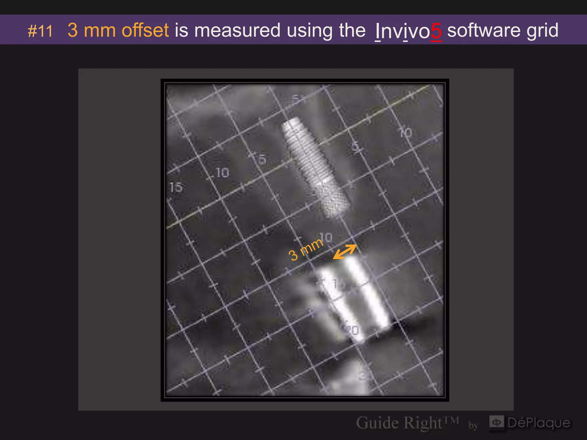 #11 3 mm offset is measured using the   Invivo5 software grid




                             `
 