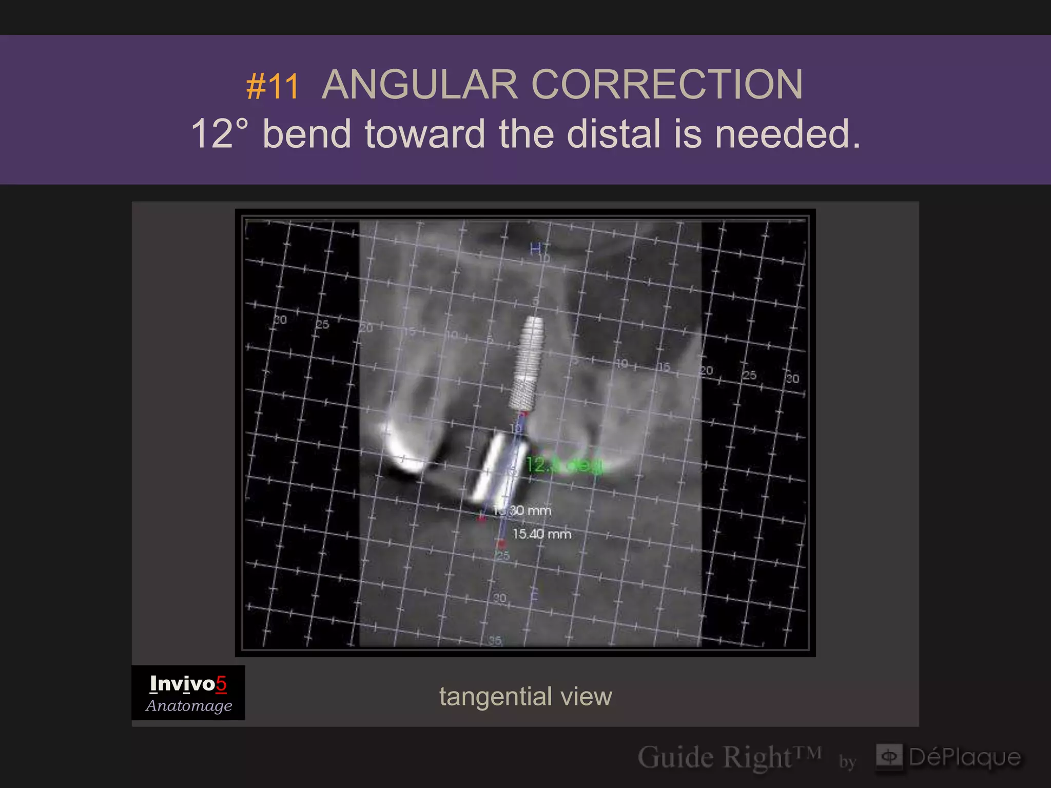 #11 ANGULAR CORRECTION
    12° bend toward the distal is needed.




Invivo5
Anatomage          tangential view
 