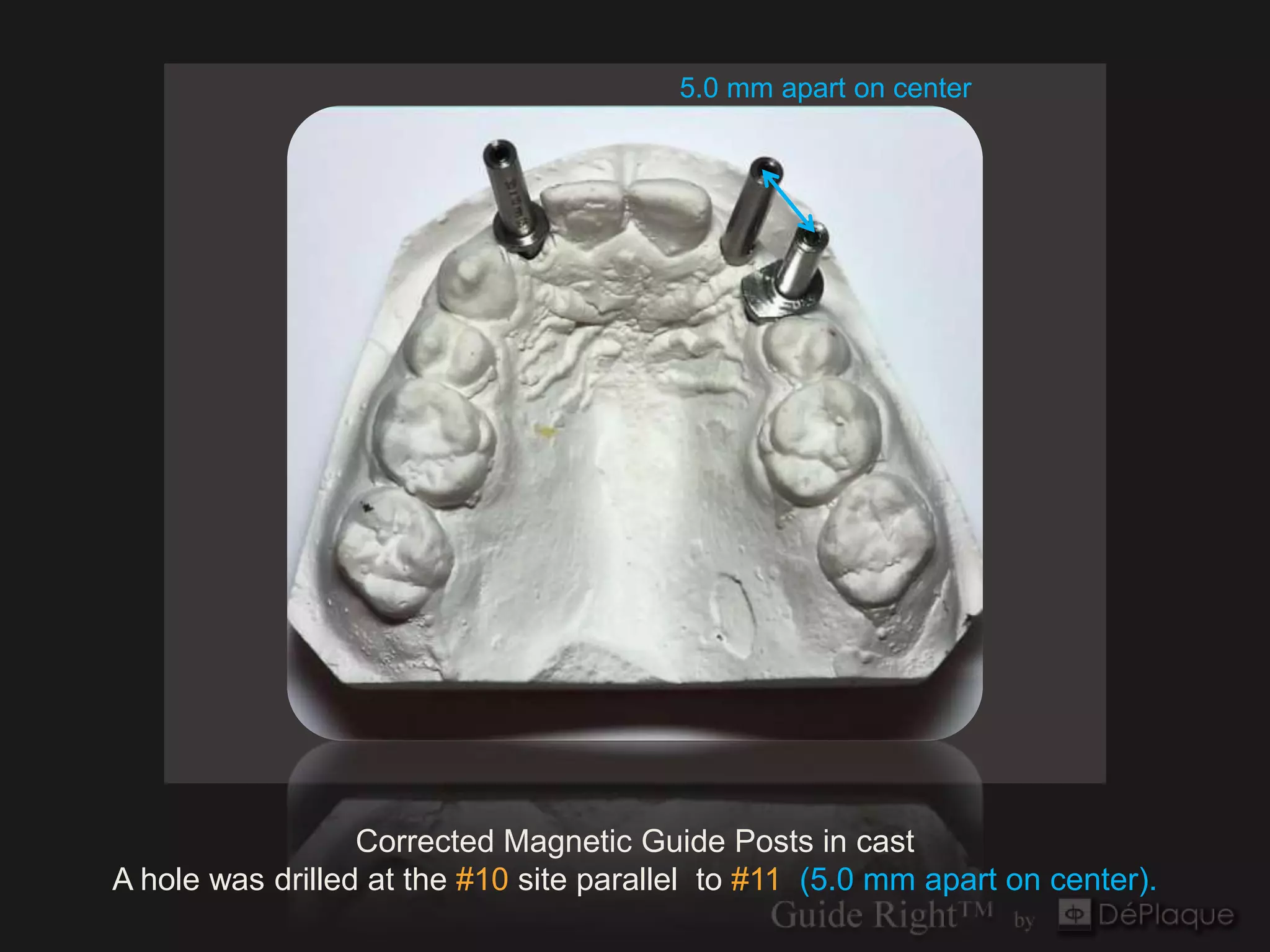 5.0 mm apart on center




                                     `




                  Corrected Magnetic Guide Posts in cast
A hole was drilled at the #10 site parallel to #11 (5.0 mm apart on center).
 