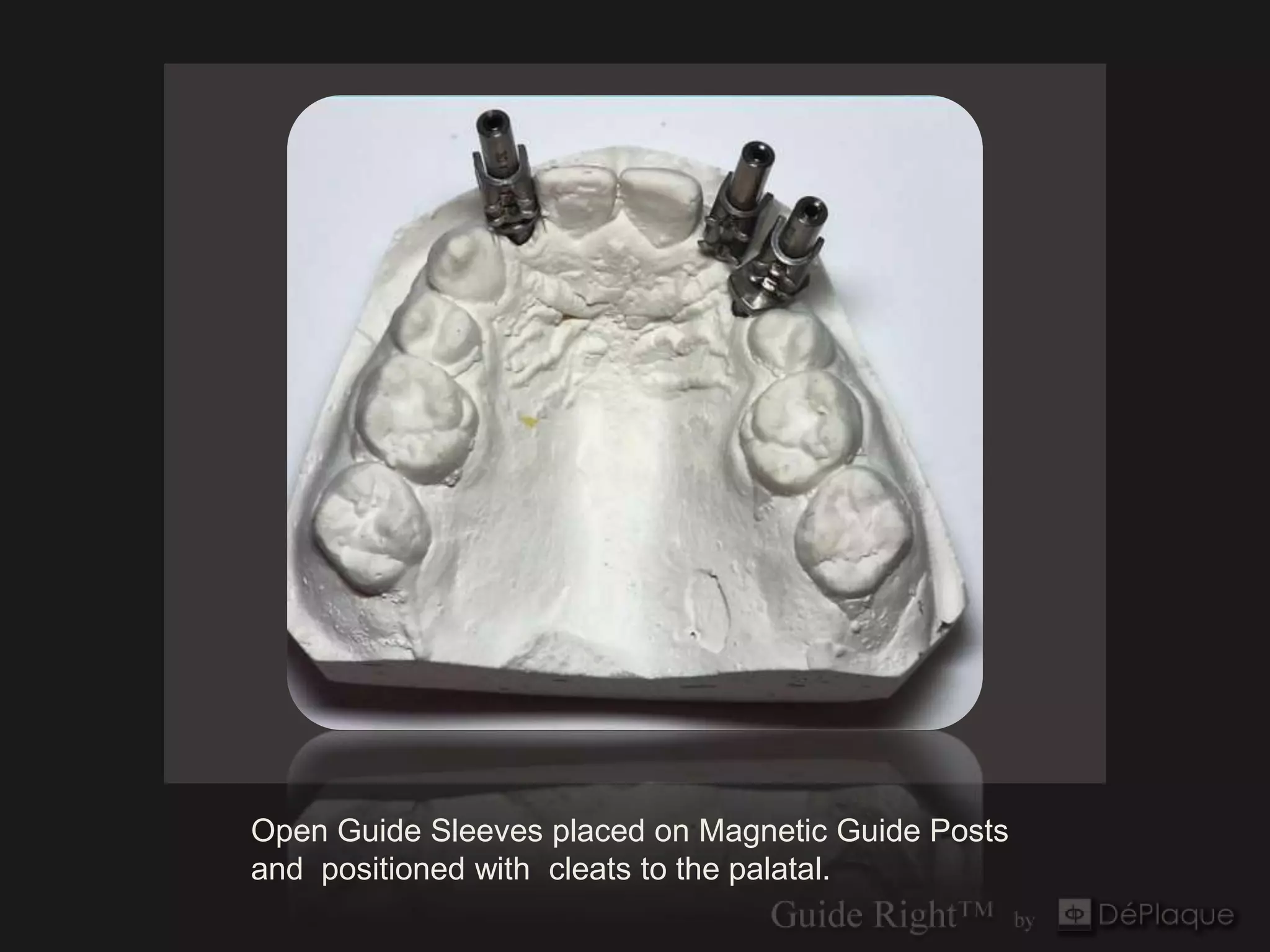 `




Open Guide Sleeves placed on Magnetic Guide Posts
and positioned with cleats to the palatal.
 