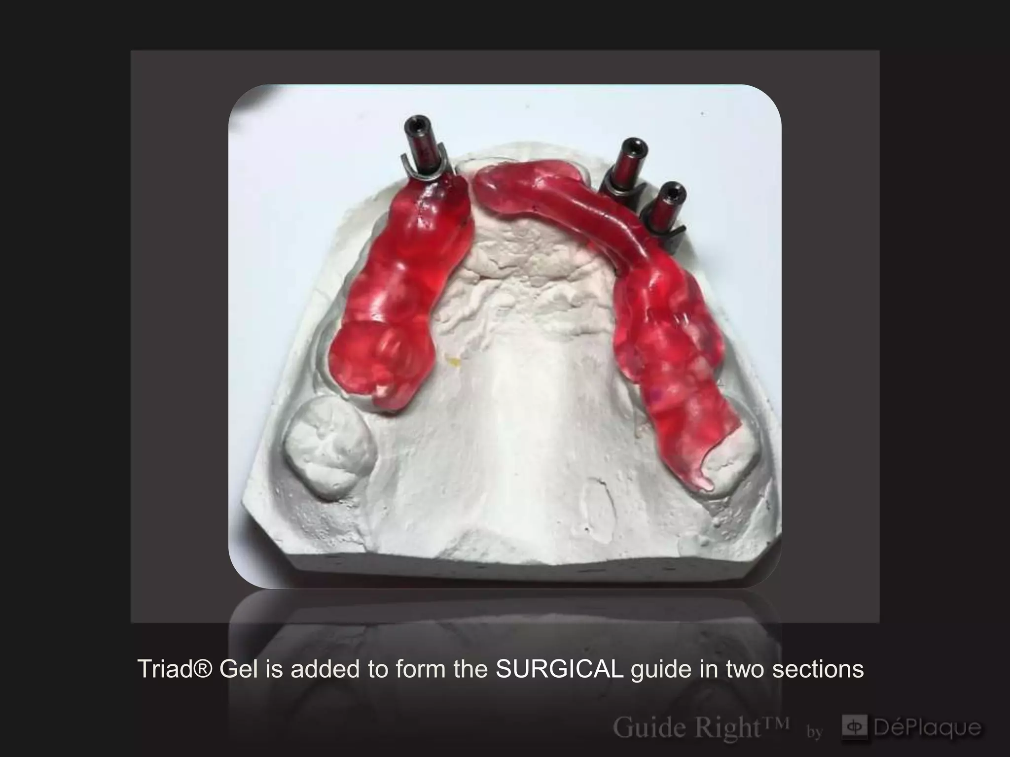 `




Triad® Gel is added to form the SURGICAL guide in two sections
 