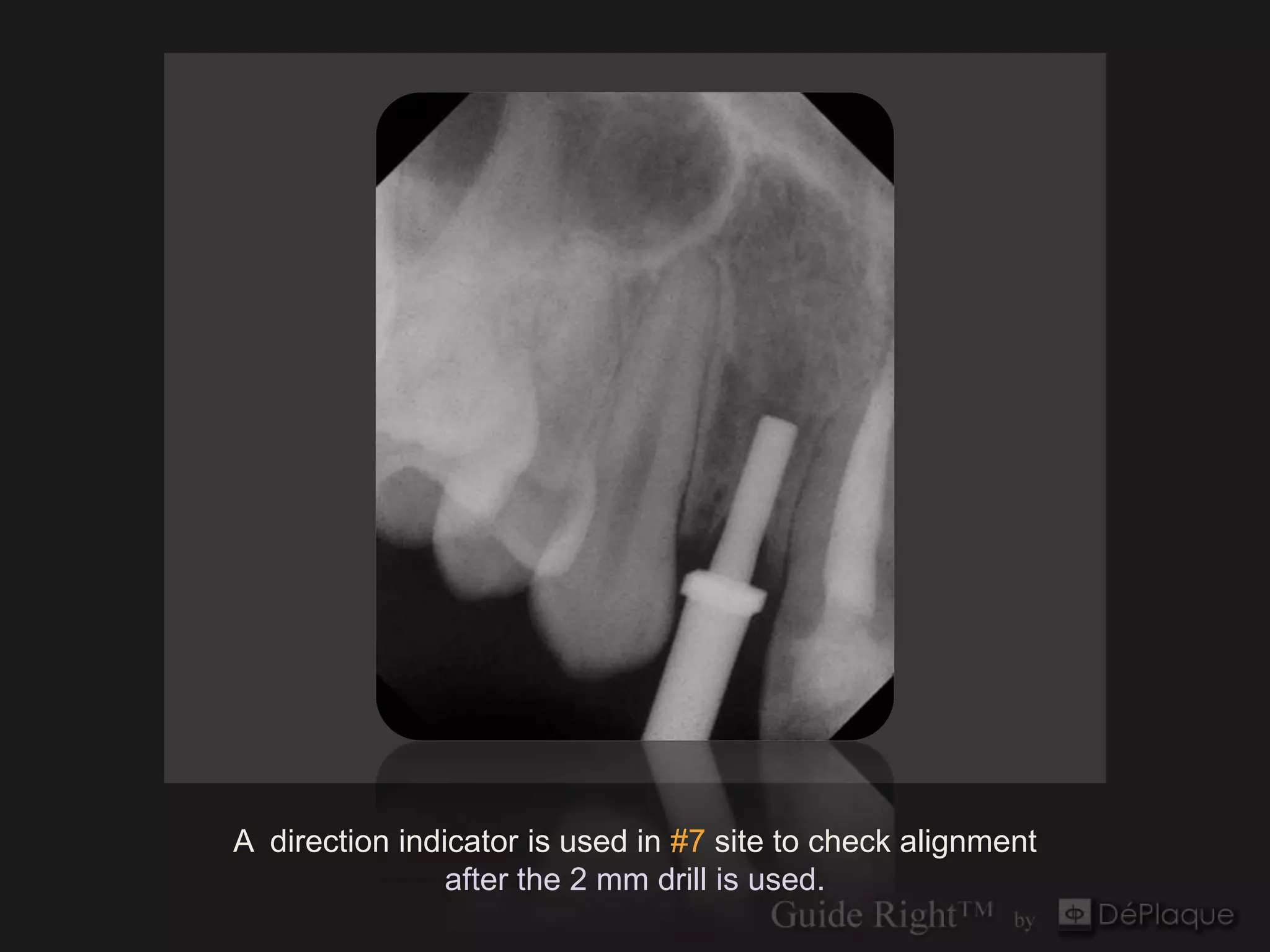 A direction indicator is used in #7 site to check alignment
                after the 2 mm drill is used.
 