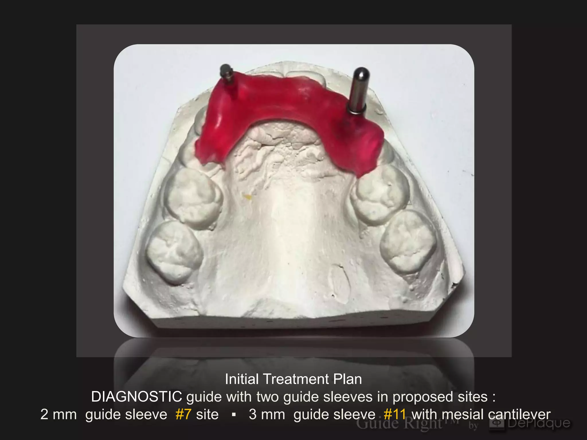 `




                         Initial Treatment Plan
      DIAGNOSTIC guide with two guide sleeves in proposed sites :
2 mm guide sleeve #7 site ▪ 3 mm guide sleeve #11 with mesial cantilever
 